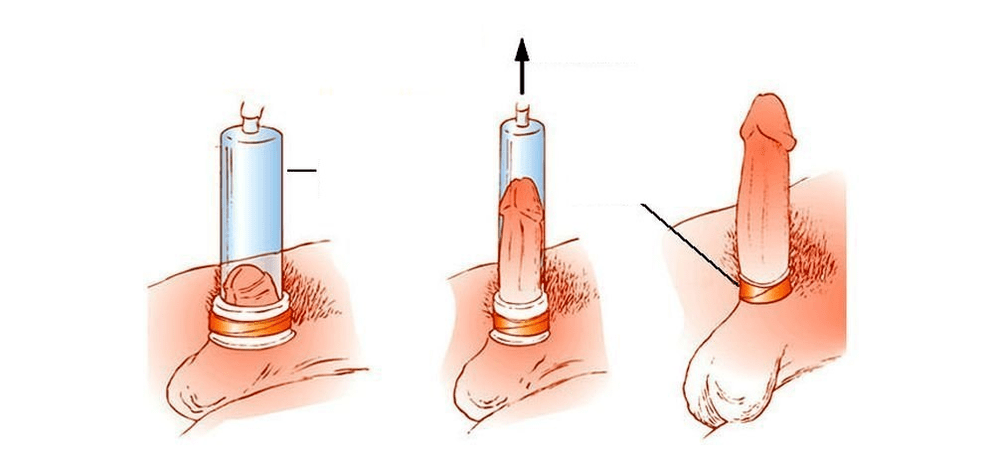 Așa funcționează o pompă de vid pentru mărirea penisului