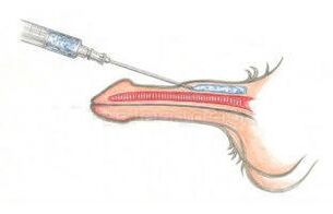 Injectați acid hialuronic sub piele pentru a face penisul mai gros