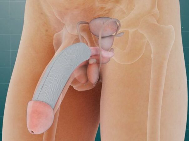 Penisul după un implant special a fost plasat sub piele