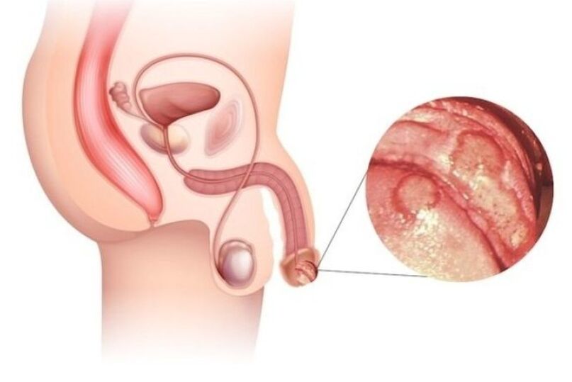 mărirea penisului mic și a glandului